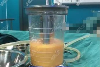 湘阴360度水动力吸脂费用多少钱？
