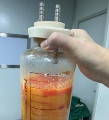 湘阴水动力吸脂手术要做多久？